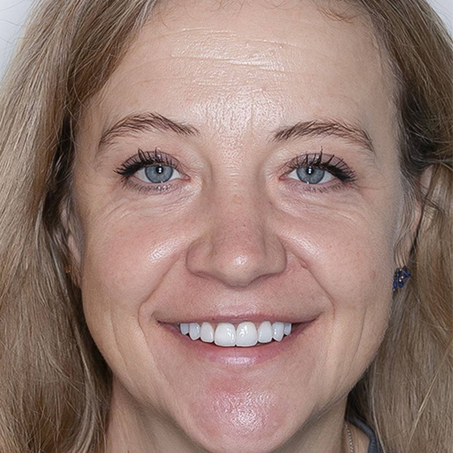 Maiely - composite veneers - after - Carmen - 3dental